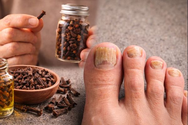 Clavos de olor para eliminar hongos en las uñas de forma natural y efectiva